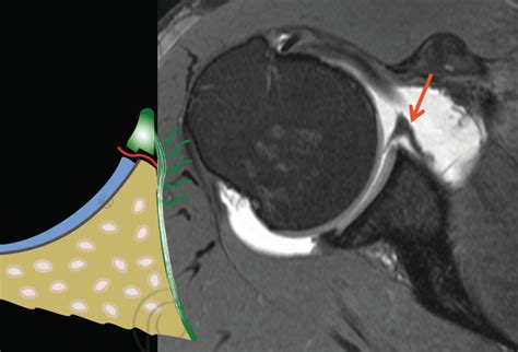 Perthes lesion .